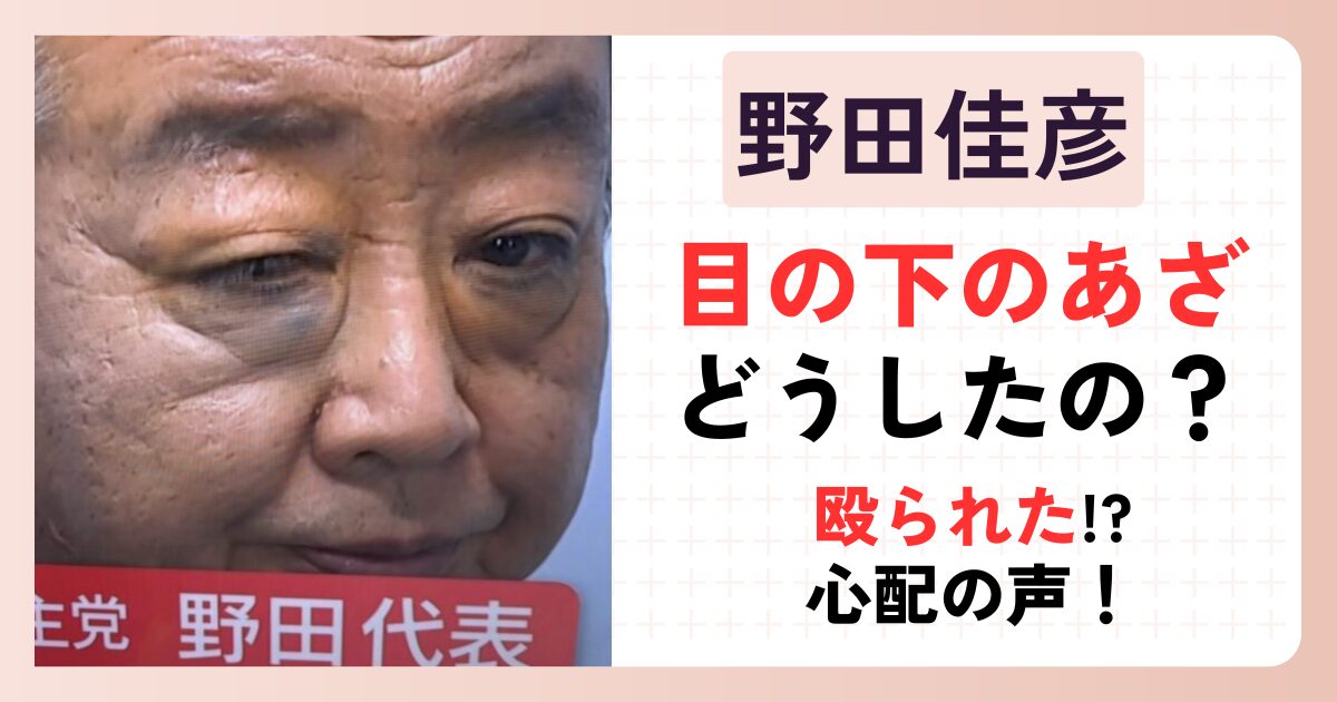 【画像】野田佳彦さんの目の下のあざはなぜ？殴られた？と心配の声！